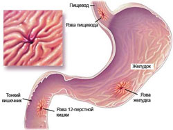 Язвенная болезнь